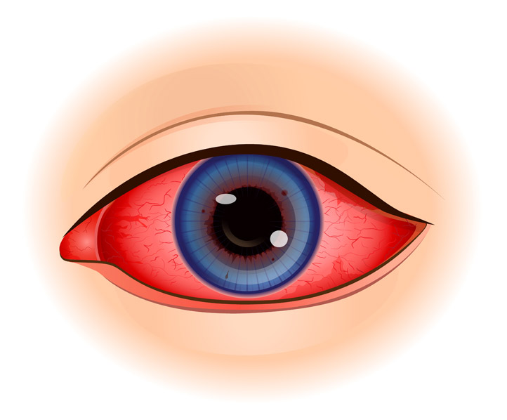 red eye due to cornea treatment