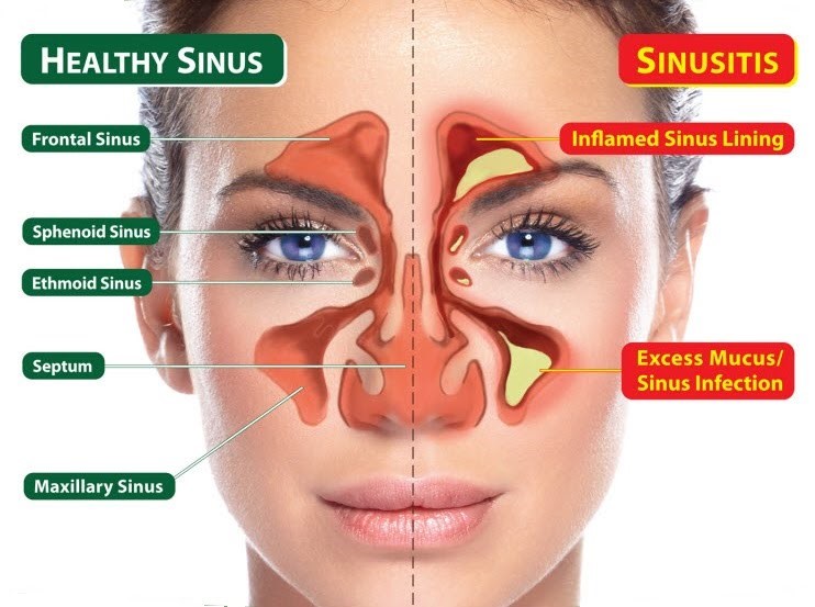 healthy and bad sinus diff show