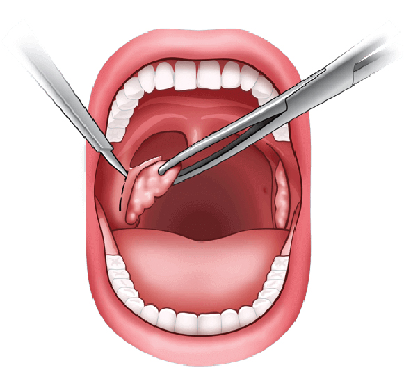 teeth inside tonsils hod through tongs