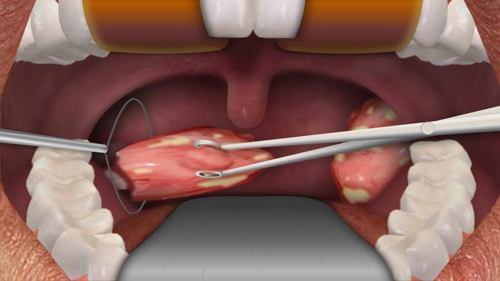 remove tonsils through tongs