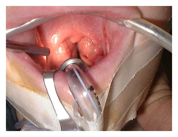 mouth tonsil surgery closeup img with hold